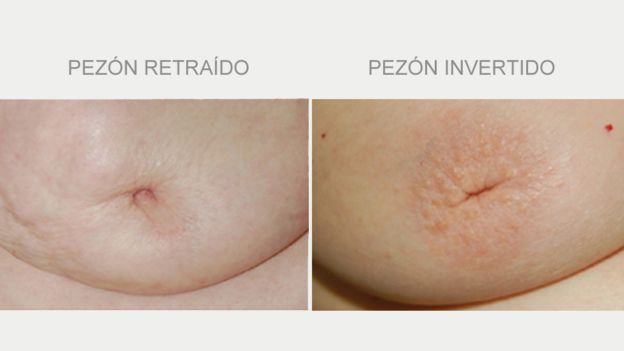 La retracción, en la gran mayoría de los casos, incluye también la retracción de la areola (izquierda), mientras que la inversión suele afectar solo al pezón y se ve generalmente como si hubiera una hendidura en forma de una pequeña línea recta, según la doctora del Río. (Foto, NHS)