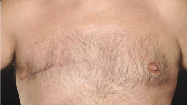 Un pezón que empieza a retraerse sobre sí mismo también puede ser un síntoma de cáncer de mama en los hombres. (Foto, Universal Hospital of Wales)