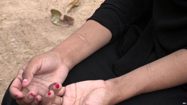 Shafa todavía tiene cicatrices en sus brazos en su intento de suicido para evitar el matrimonio forzado.